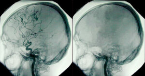 Brain death is the complete and irreversible loss of all brain function.